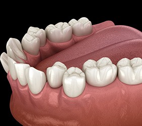 Illustration of crooked teeth