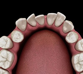 Illustration of underbite