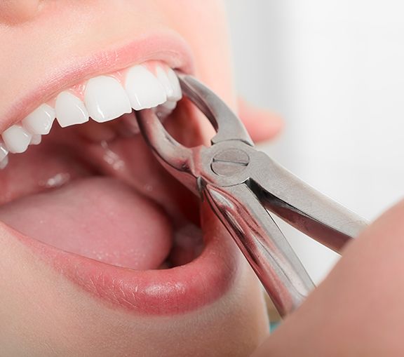 Closeup of a woman’s tooth being grasped by forceps