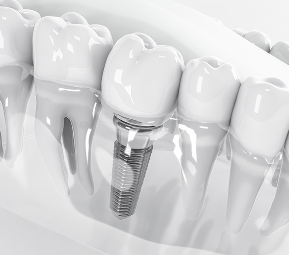 Rendering of a dental implant in a shiny, clear lower jaw with a white background