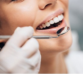 Nose-to-neck view of someone smiling as a dentist with white gloves holds mirror to their teeth