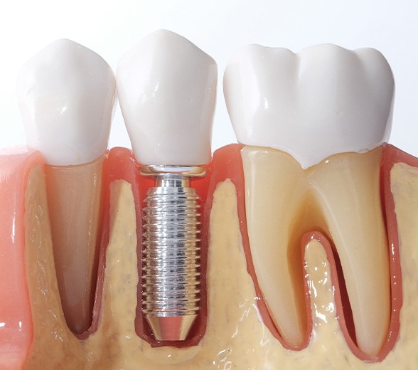 Closeup of a sample implant in a model jaw with a white background