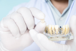 Close up of a dentist handling a dental implant crown and model