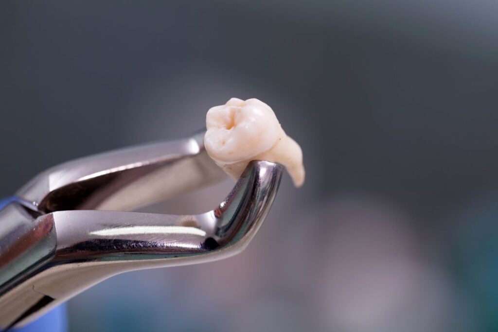 A tooth that has been extracted.