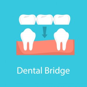 dental bridge illustration